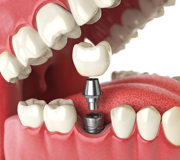 Marietta Will I Need a Bone Graft for Dental Implants