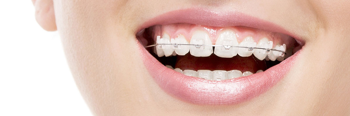 Marietta Invisible Orthodontics