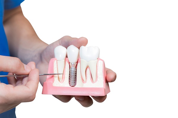 Signs You May Need Dental Implants