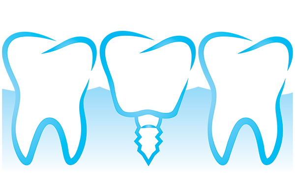 The Lifespan Of Dental Implant Restorations