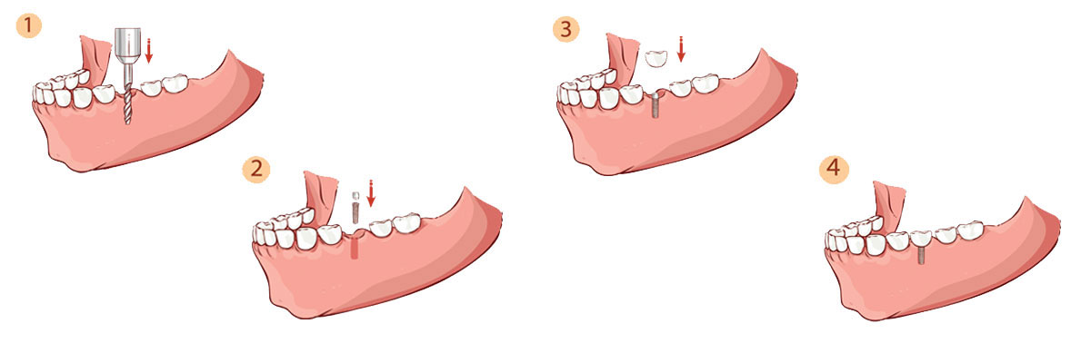 Marietta Dental Implant Restoration
