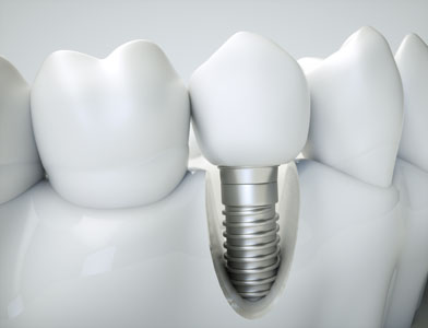 Learn More About Dental Implant Options From A Cosmetic Dentist