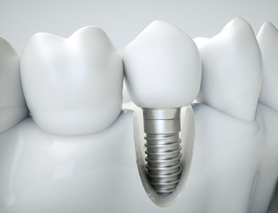 Dental Implants