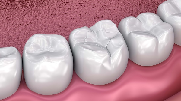 How Does Dental Sealant Treatment Work?