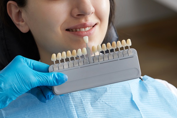 What To Know About The Dental Veneers Procedure