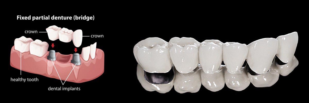 Marietta Dentures