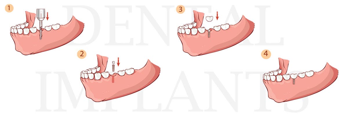 Marietta The Difference Between Dental Implants and Mini Dental Implants
