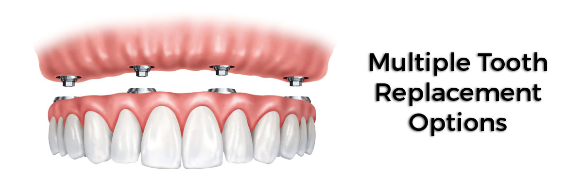Marietta Multiple Teeth Replacement Options