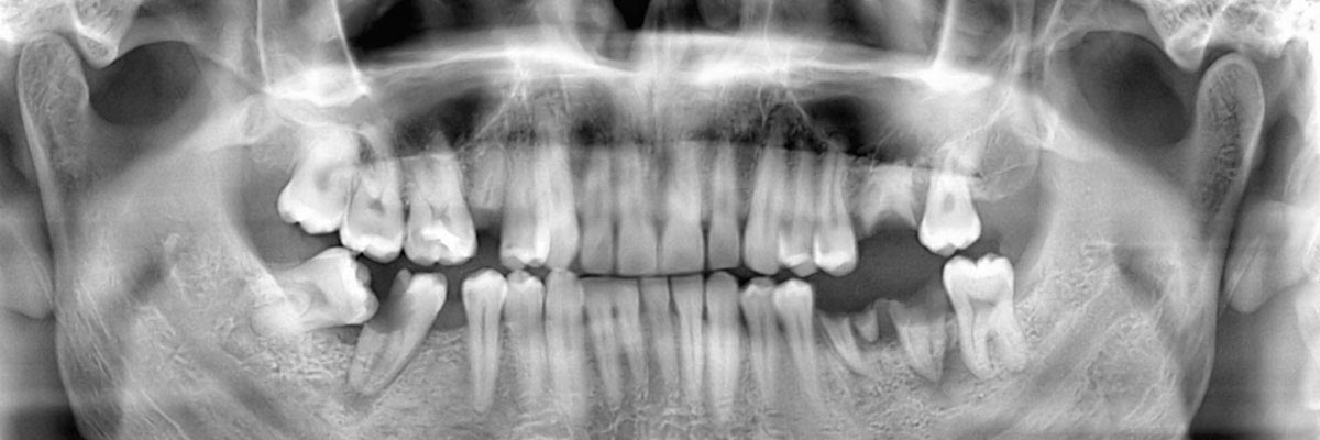 Marietta Options for Replacing Missing Teeth