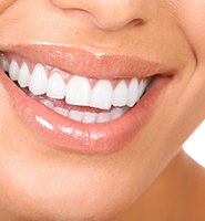 Teeth Whitening Services Marietta, GA
