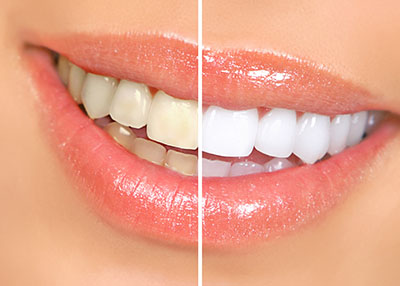 Answers To The Most Commonly Asked Teeth Whitening Questions