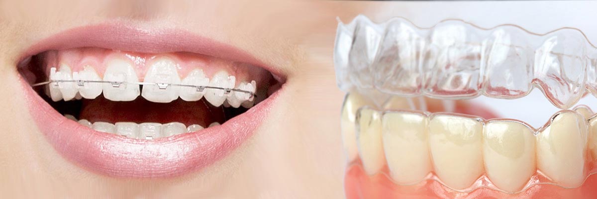 Marietta Which is Better Invisalign or Braces